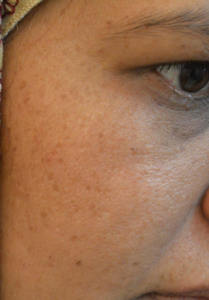 Black Spots Laser Treatment